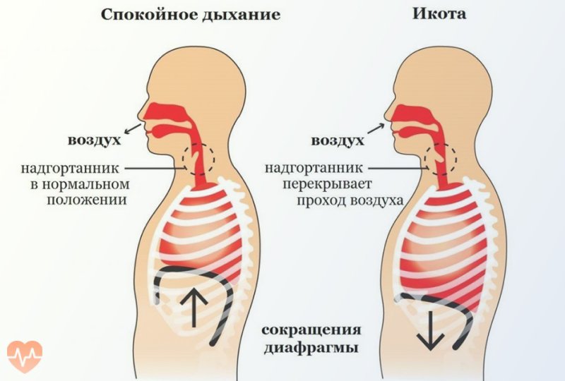 Как происходит икота